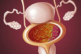 Cistite bacteriana nunha muller